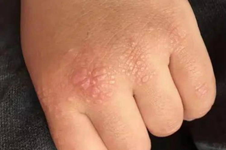 皮肌炎手背症状图