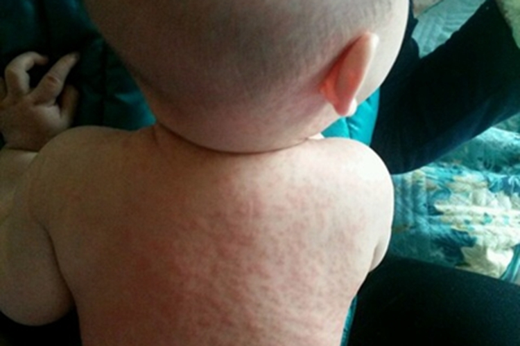 界限类偏瘤型麻风背部丘疹图 界限类偏瘤型麻风背部丘疹图