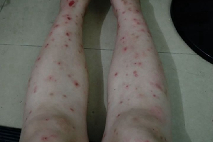 跳蚤叮咬小腿疙瘩图 跳蚤叮咬小腿疙瘩图