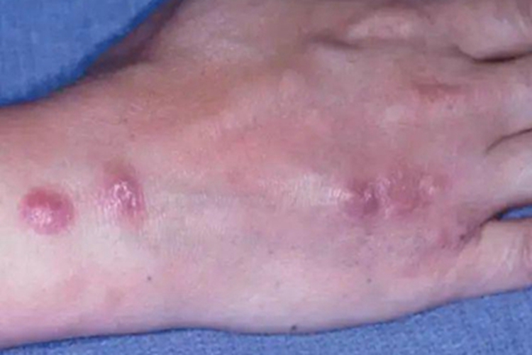 皮肤型组织胞浆菌病结节图