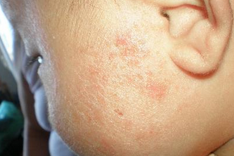 婴儿干燥型湿疹图