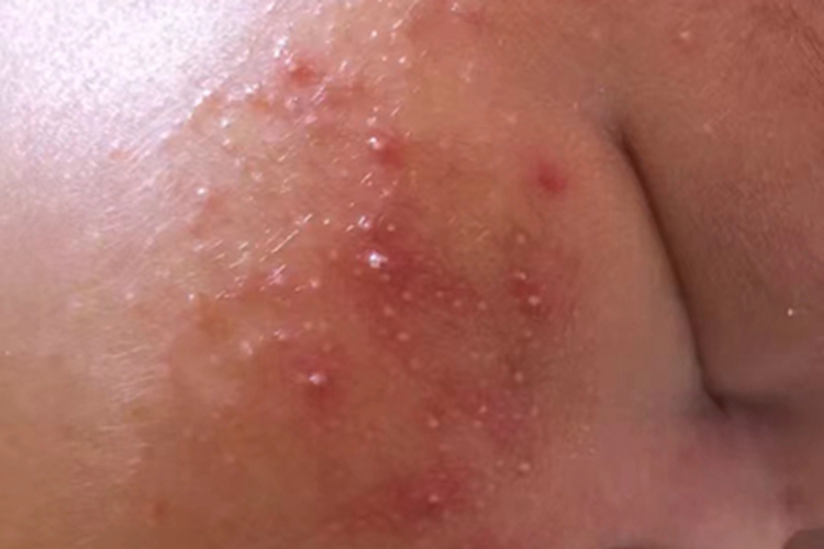 新生儿痤疮白头粉刺图 新生儿痤疮白头粉刺图