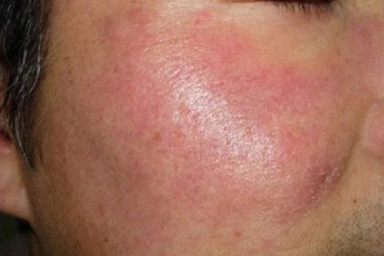 面部日光性皮炎图