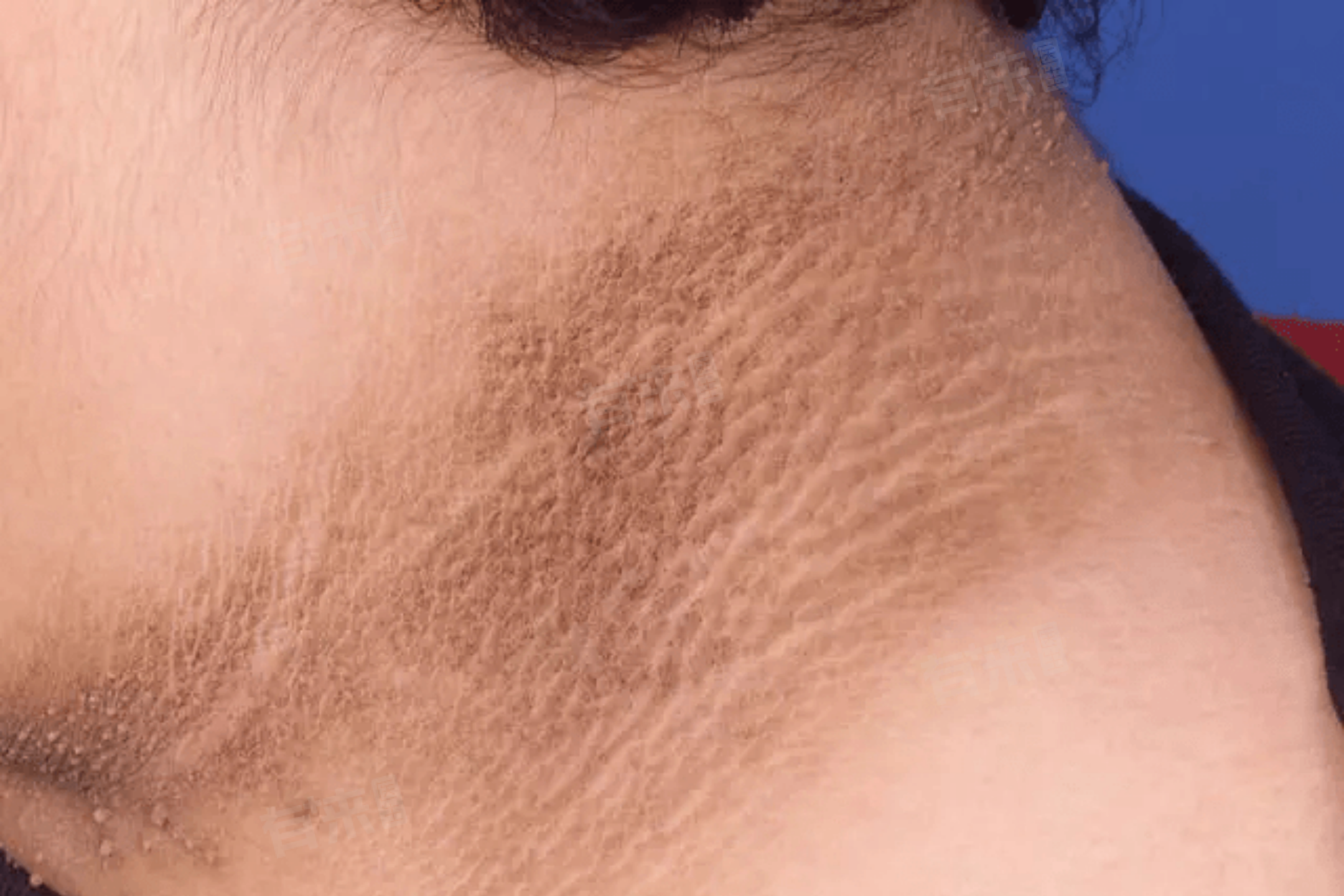 脖子后面黑色素沉淀怎么消除