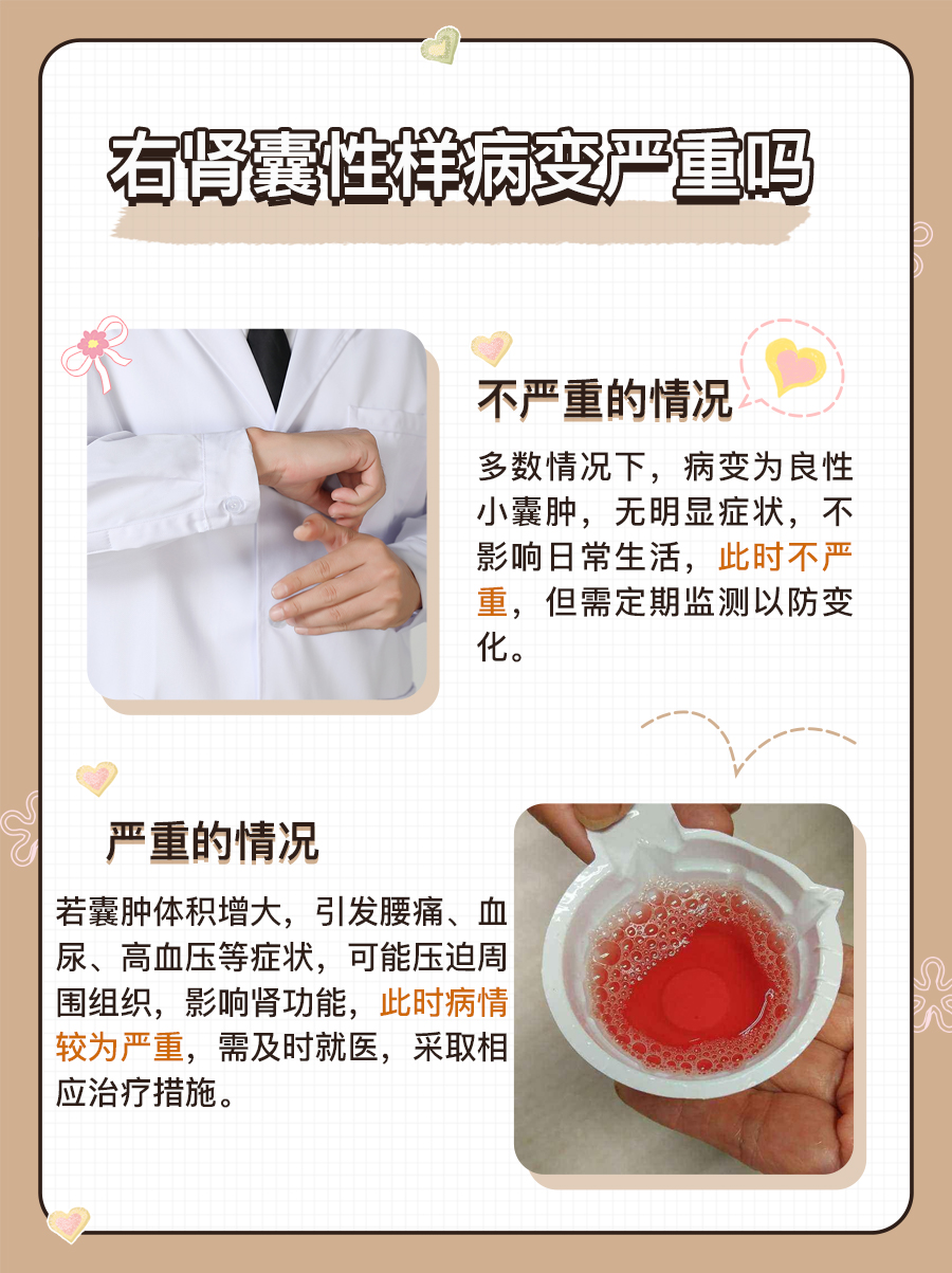 解疑答惑：右肾囊性样病变严重吗？