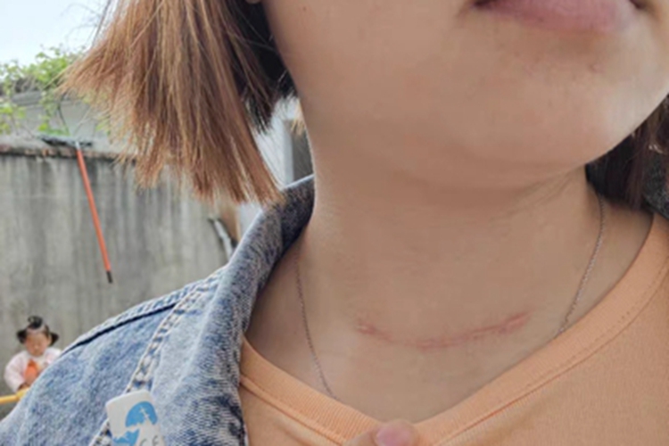 瘢痕疙瘩前颈部有线形瘢痕图