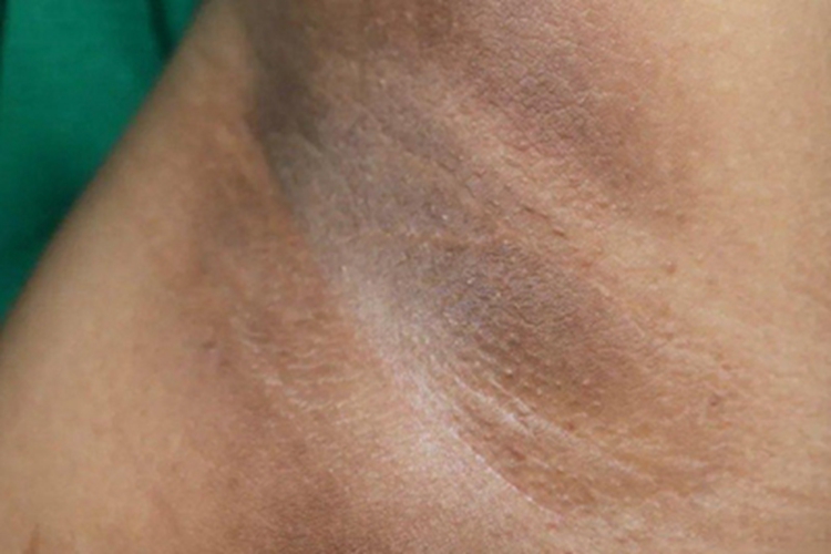 假性黑棘皮病腋窝发黄发黑图