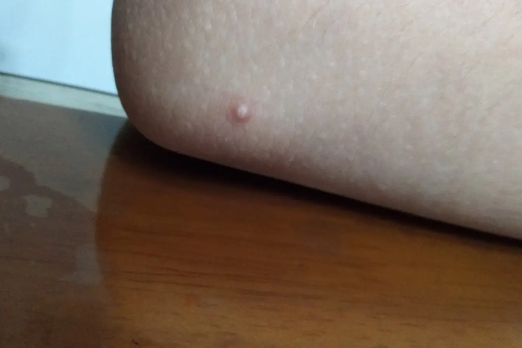胳膊肘上长闭合性粉刺图