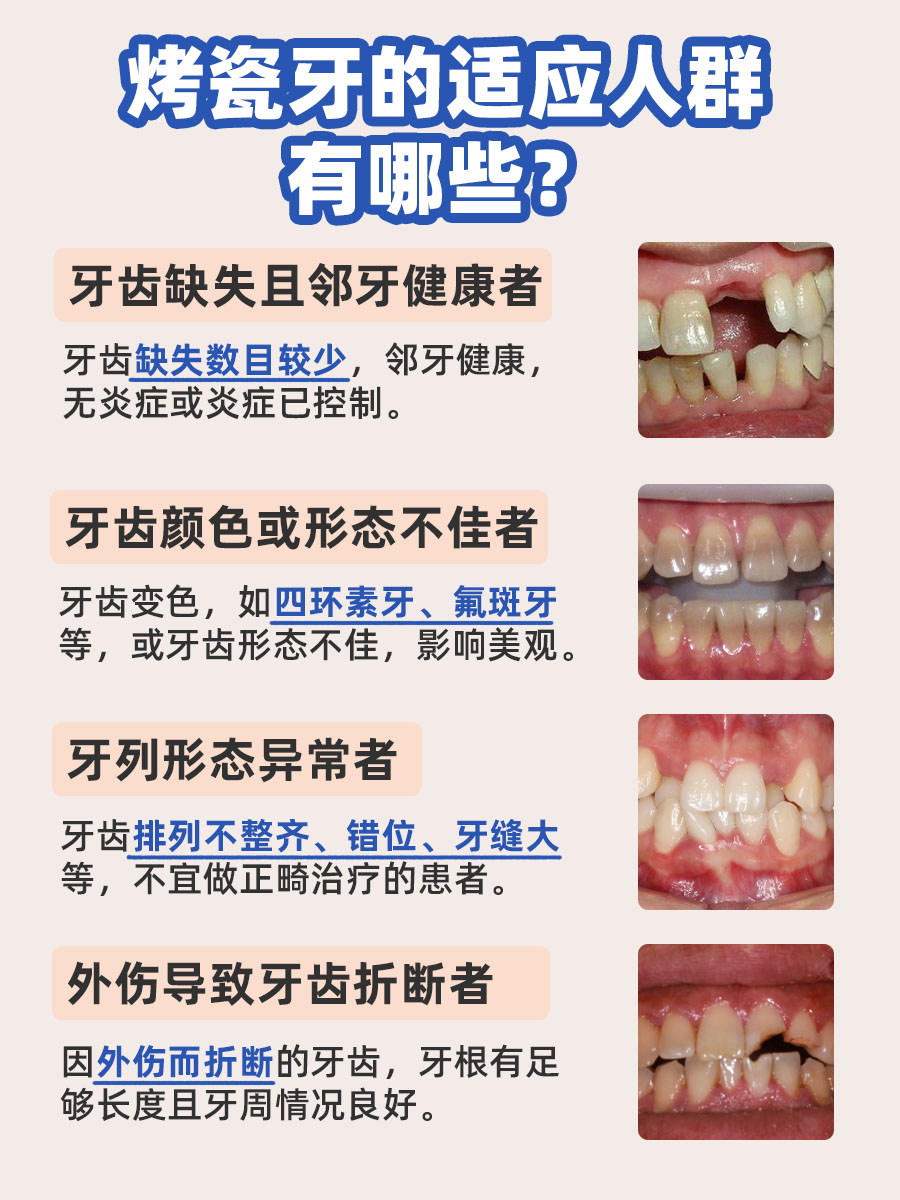 烤瓷牙取下来究竟遭不遭罪？一文给你答案