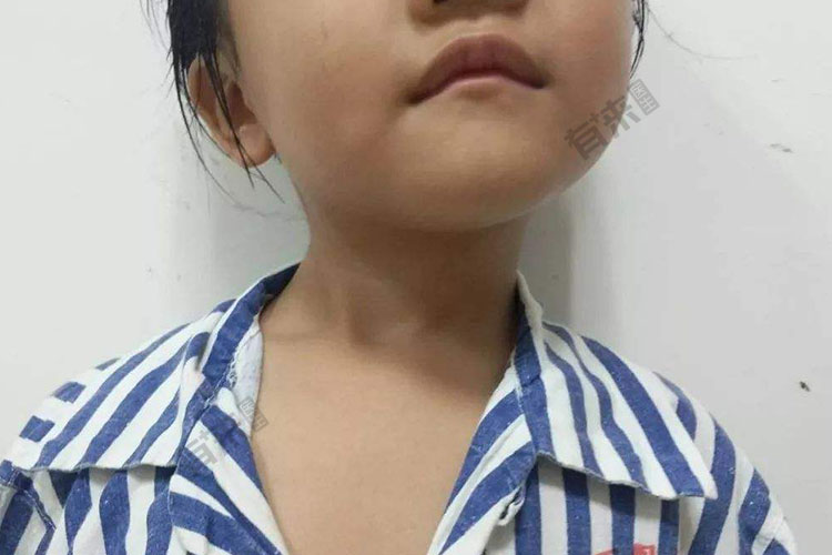 宝宝斜颈头偏图