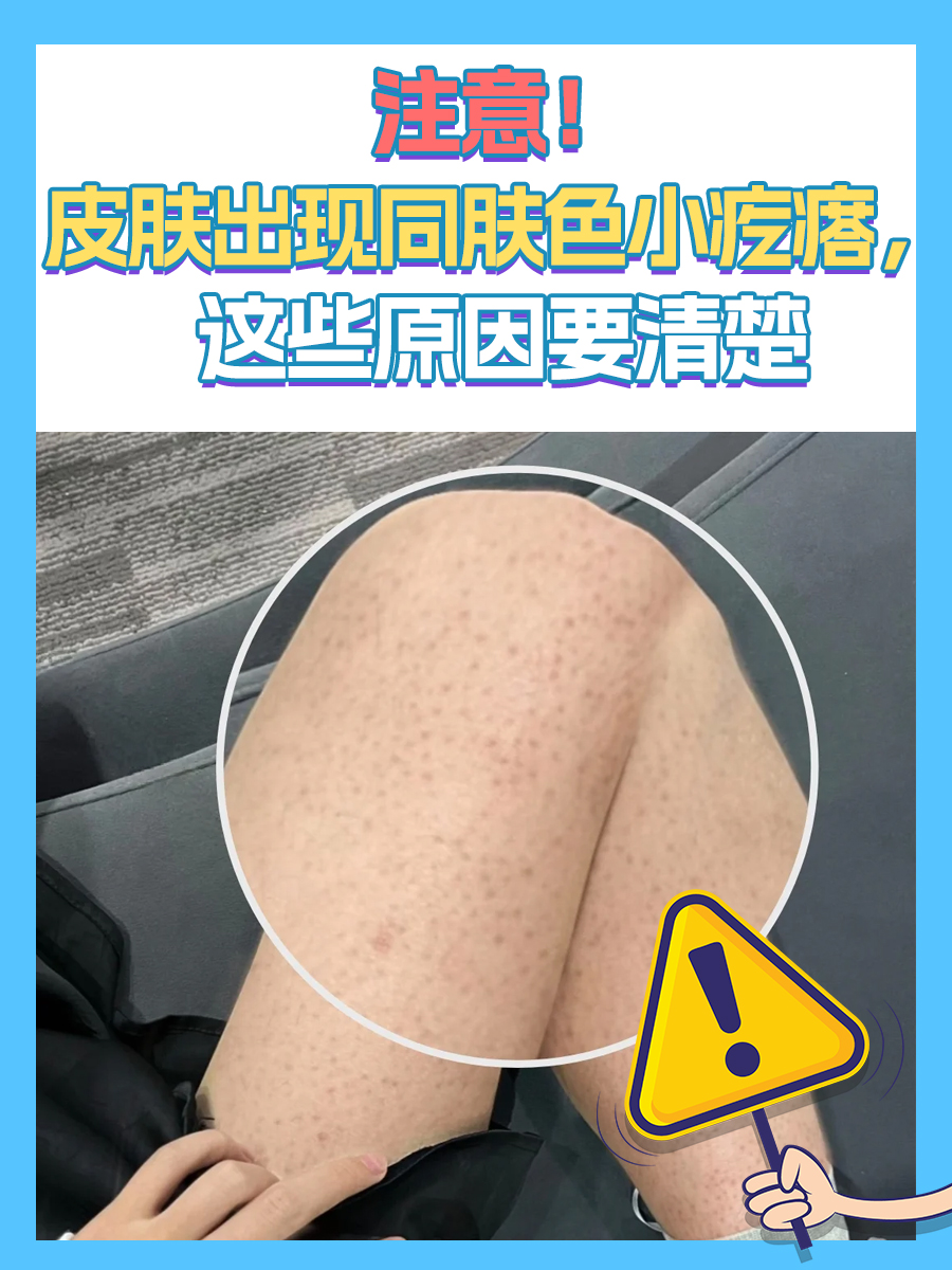 注意!皮肤出现同肤色小疙瘩,这些原因要清楚