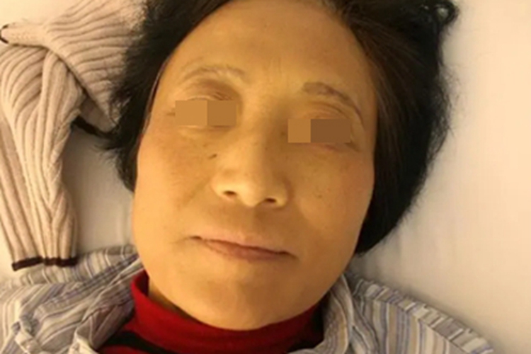 胡萝卜素血症面部皮肤发黄图