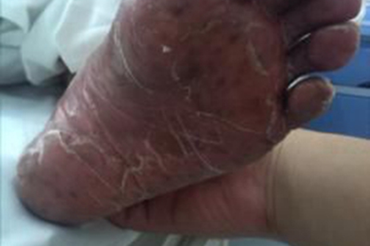 手足综合征脚底皮肤发黑图 手足综合征脚底皮肤发黑图