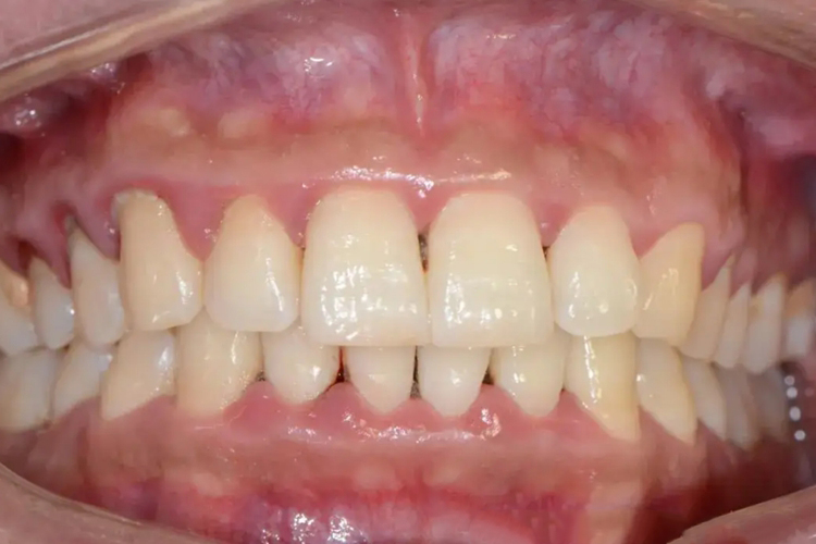 牙槽骨肉眼观图