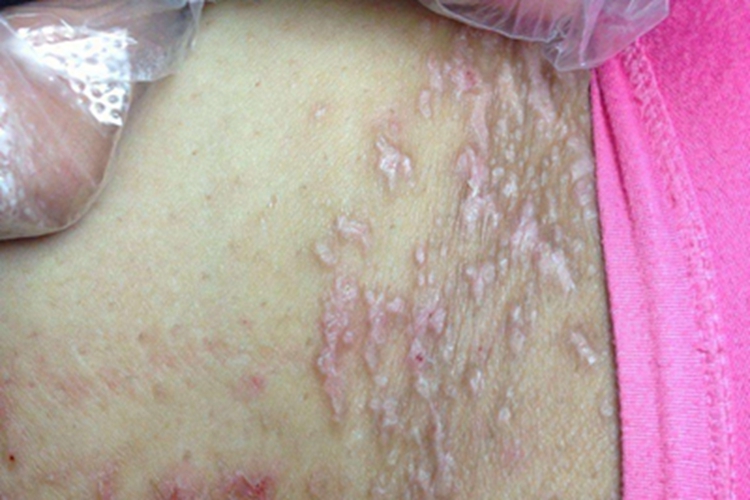 扁平苔藓样接触性皮炎腰部斑图