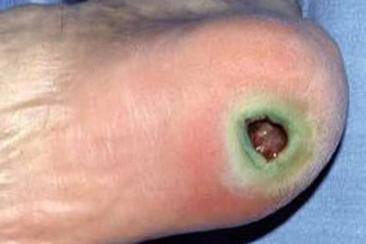 坏疽性臁疮脚后跟大坑图