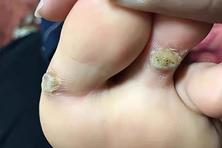 寻常疣脚趾出现灰色结节图