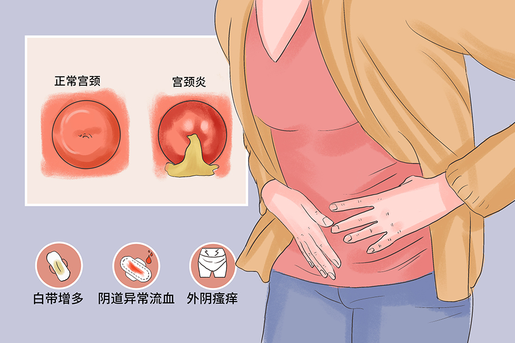 宫颈炎有哪些症状早期图片