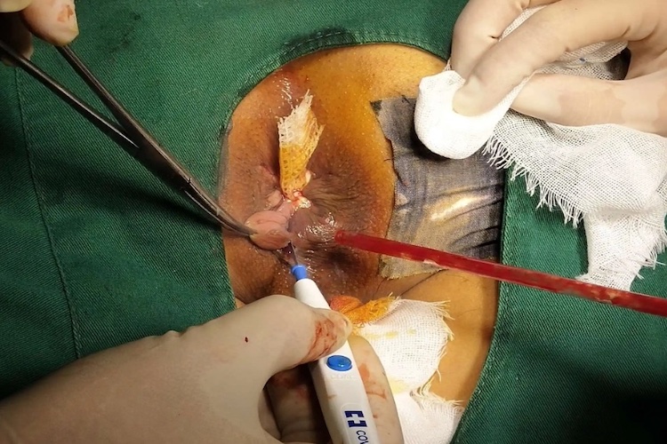 外剥内扎术手术步骤图