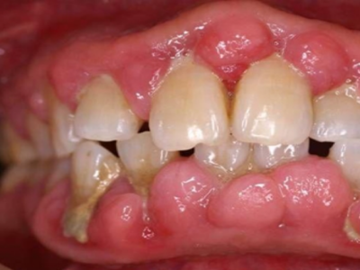 牙龈增生肥大的图片图片
