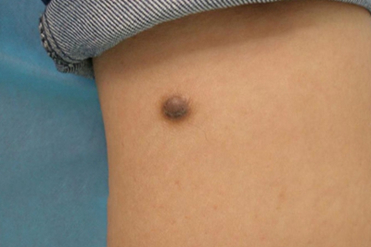 皮肤纤维瘤小腿结节图