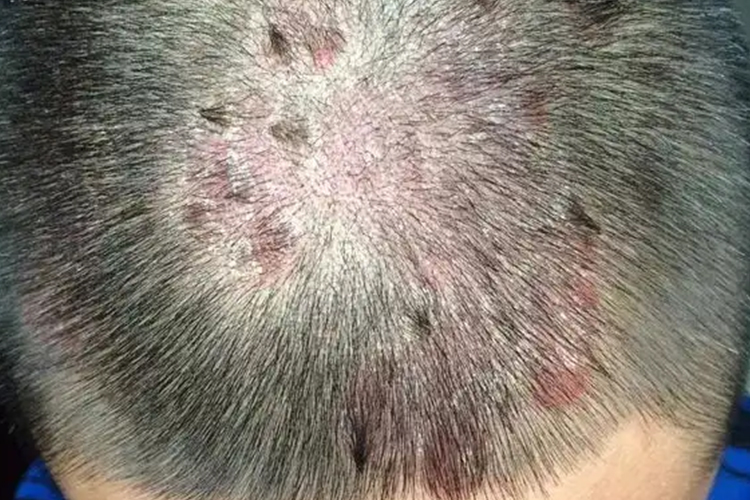 头皮牛皮癣早期症状图