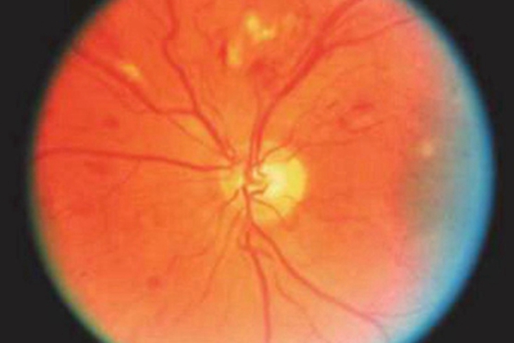 慢性高血压视网膜病变血点图 慢性高血压视网膜病变血点图