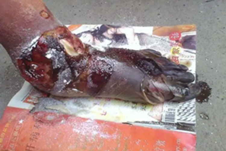 电弧烧伤脚部症状图