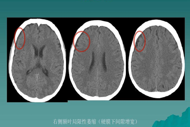 局限性脑萎缩图 局限性脑萎缩图