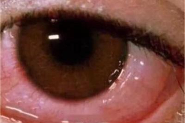 儿童过敏性结膜炎眼部红肿图