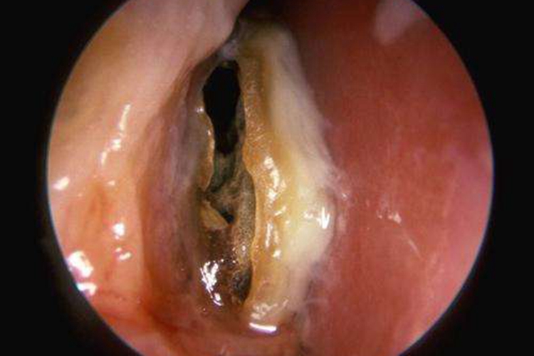 鼻子干酪样分泌物图