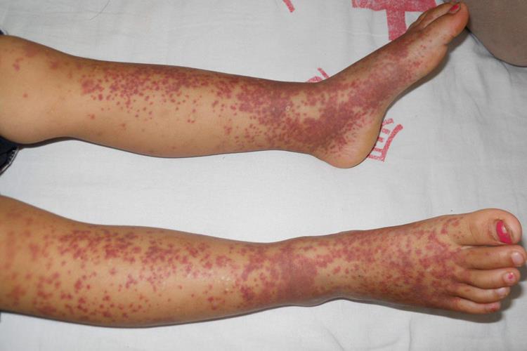 过敏性紫癜皮肤上紫点点图