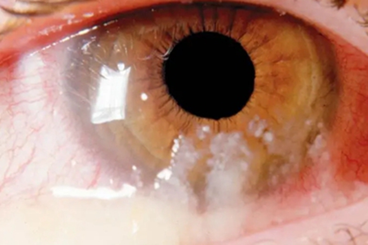 细菌性结膜炎结膜化脓图