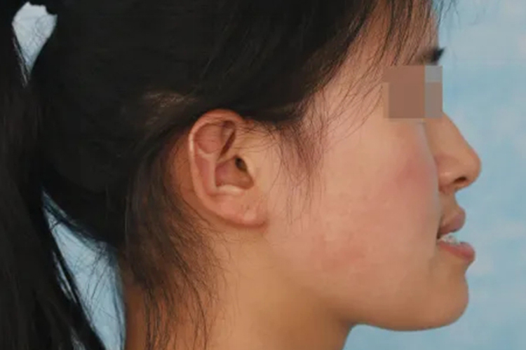 小孩下颌发育畸形图 小孩下颌发育畸形图