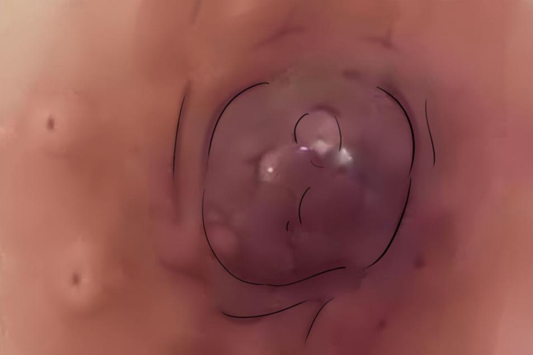 乳腺癌乳头溢液图 乳腺癌乳头溢液图