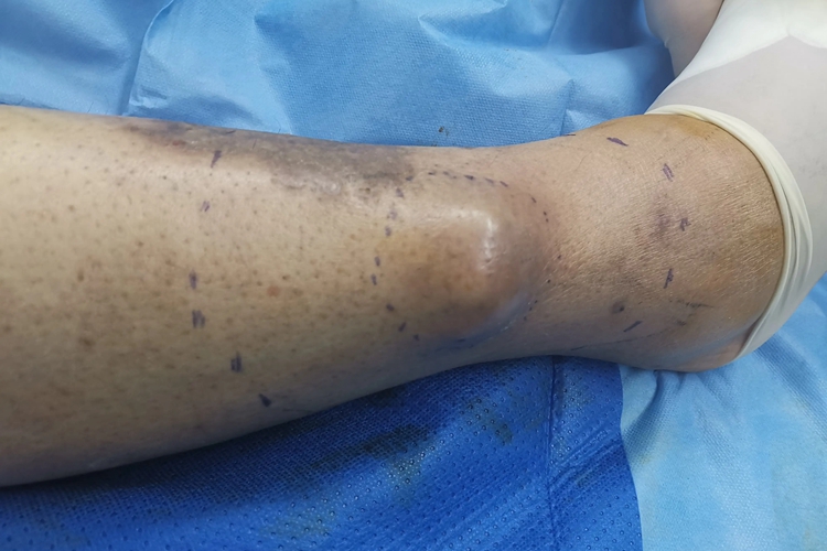 腿上骨肉瘤图 腿上骨肉瘤图