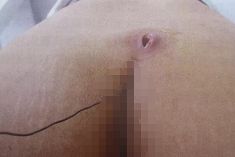 骶尾部藏毛窦大坑图