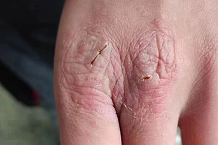 慢性湿疹手部皮肤粗糙图 慢性湿疹手部皮肤粗糙图