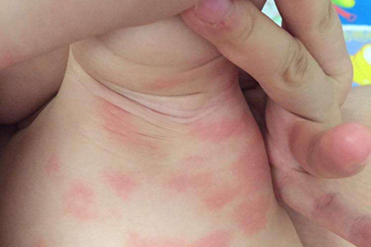 新生儿中毒性红斑症状图