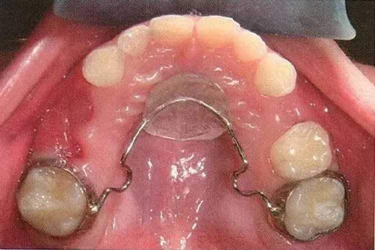 舌弓式间隙保持器图
