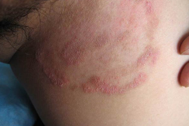 股癣腹股沟长红斑图