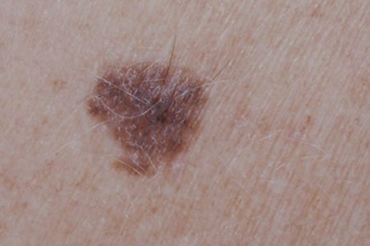 早期恶性黑色素瘤图 早期恶性黑色素瘤图