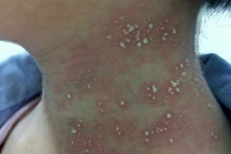 隐翅虫皮炎颈部脓包图