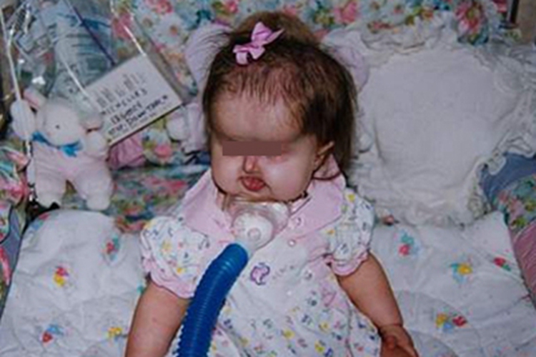 短肢侏儒免疫缺陷头部畸形图