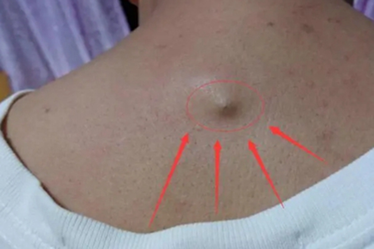 扩张孔背部症状图