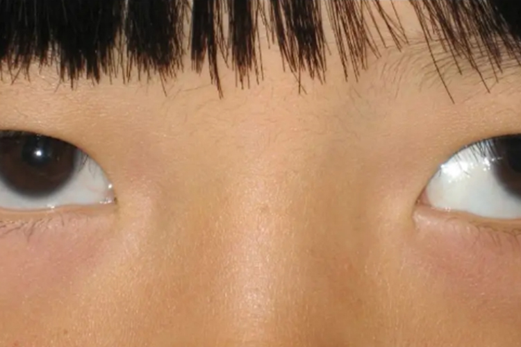 间歇性外斜视图 间歇性外斜视图