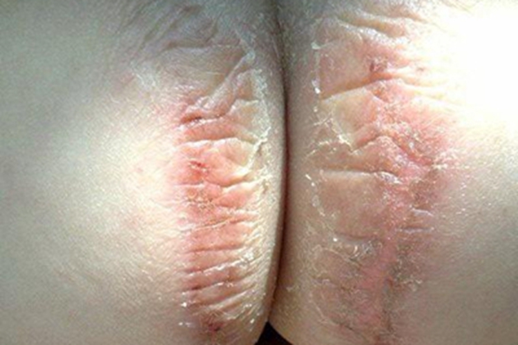 尿布皮炎出现脱屑图