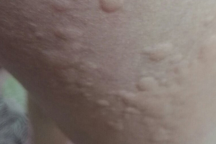 女性大腿过敏风团图