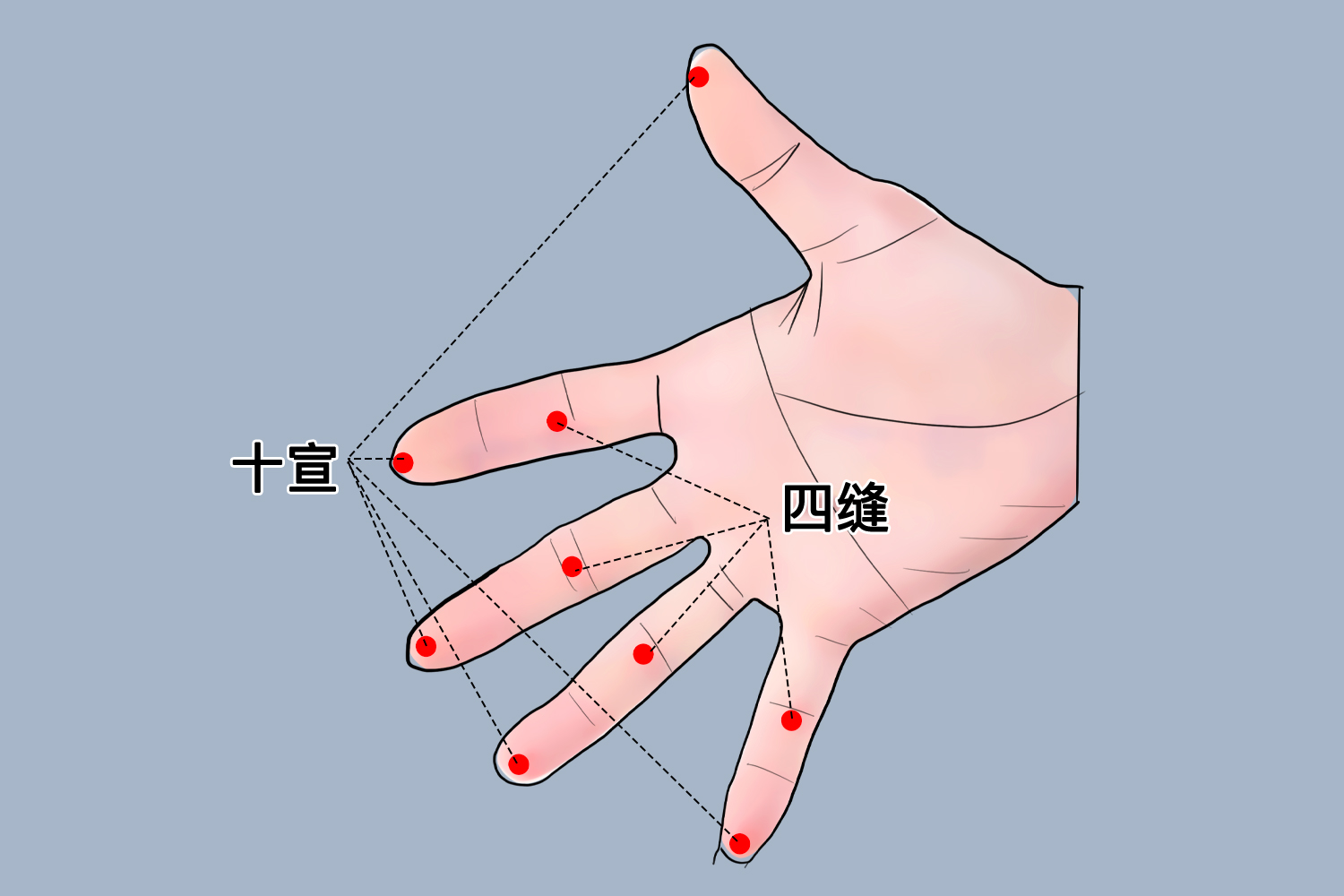 四缝穴、十宣穴位置图