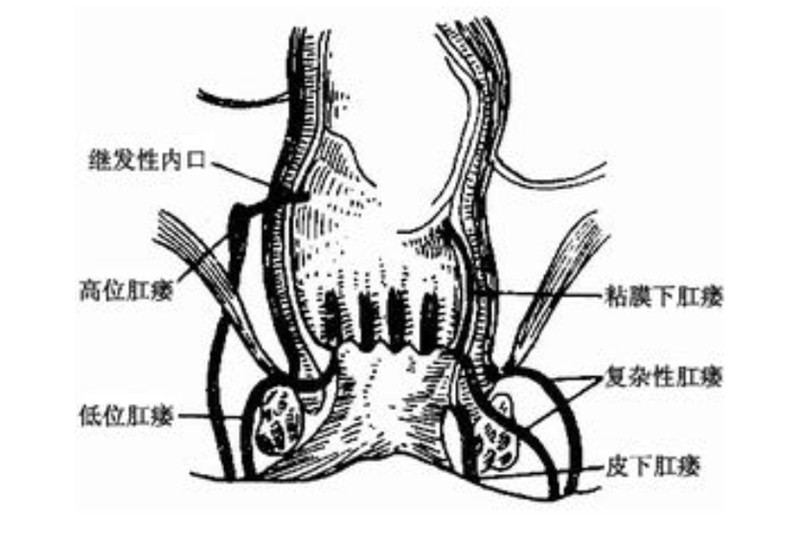 小儿肛瘘的症状图片图片